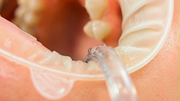 中山伺服超声波塑料焊接机：医用扩张器焊接生产中的创新应用